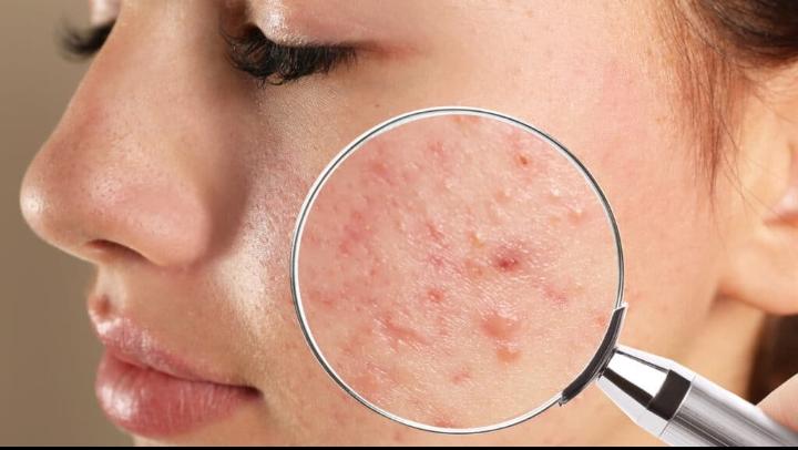 Acne facial